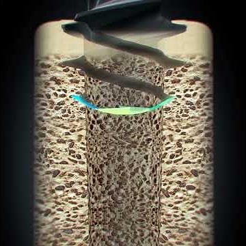 Straumann® BLX Implant System - Slim Osteotomy with Deep Threads Dynamic Bone Management