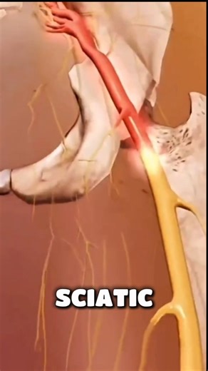 Sciatica Explained: Why Your Leg Hurts from Your Back #discus #hernia #sciatica