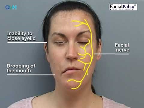 Understanding Facial Palsy