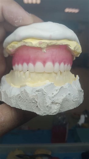 only upper complete denture tooth setup for trial #dentist #smiledesigndental #mobiledentistry