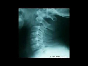 Time-Lapsed Disc Degeneration of the Neck - Mississauga Pain Clinic