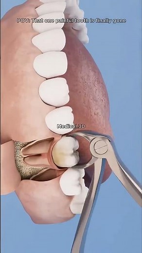 Inside Tooth Extraction 😳 What Really Happens? 🦷 #fyp #ToothExtraction #DentalReveal