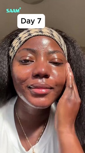 🎯 Still fighting melasma, dark spots after trying so many creams? Here’s the skincare breakthrough everyone is talking about 👇 💎 Renewal Face Cream – Advanced pigmentation corrector trusted by thousands! - Removes melasma, dark spots, sun spots & pigmentation - Visible results in just 2–3 weeks - Evens skin tone, remove stubborn marks - Suitable for both men and women - Works on all skin tones ✅ Dermatologist-recommended | Non-irritating 🎁 LIMITED OFFER: 60% OFF FREE delivery anywhere in GHA