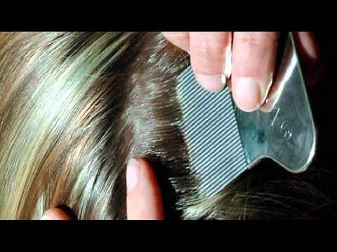 Treating lice: tips from a school nurse