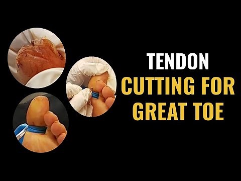 Tendon Cutting For Great Toe
