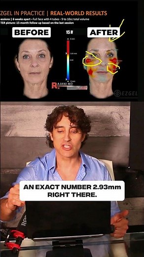 Why PRF is Dominating The Anti Aging Game !!