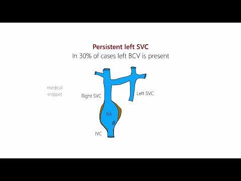 Persistent Left Superior Vena Cava (Left SVC) | Embryology and Clinical Anatomy