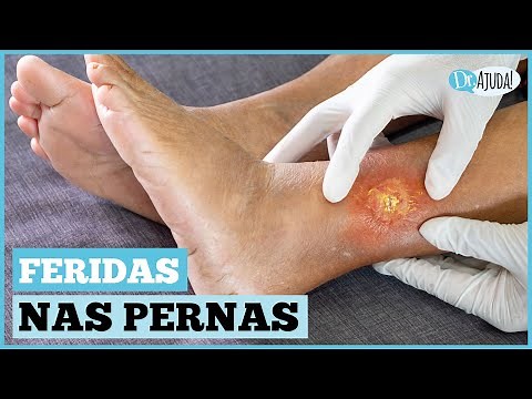 QUAIS AS CAUSAS DE FERIDAS NAS PERNAS E NOS PÉS? O QUE FAZER ?