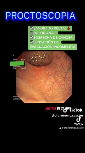 Proctoscopia: Diagnóstico de Hemorroides Internas