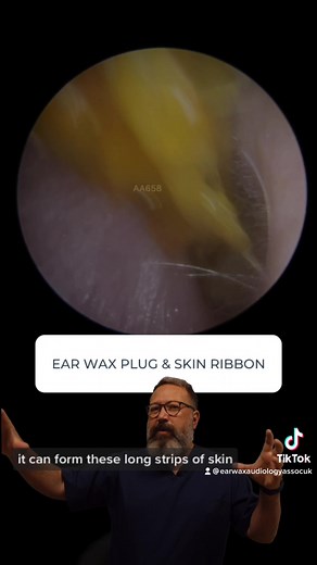 Effective Ear Cleaning: Removing Ear Wax Plugs Safely