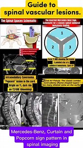 Mastering Spinal Vascular Lesions: A Pattern-Recognition Guide For radiologists, neurologists, neurosurgeons, and trainees – being able to identify these key spinal vascular lesions on imaging is crucial for timely diagnosis and management. This reel breaks down 6 major entities with their classic imaging signs: 1. Spinal Dural AV Fistula (SDAVF): T2 cord edema (flame-shaped) perimedullary flow voids 2. Intramedullary AVM: Compact intramedullary nidus with early draining veins 3. Cavernoma: "Pop