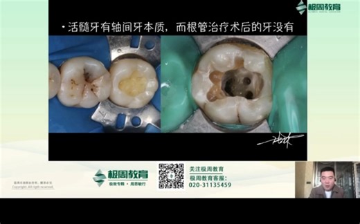 如何精确进行嵌体预备与处理龈下边缘。——《张林嵌体预备系列课程》