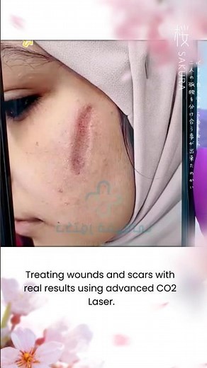 CO2 Laser for Scars: Real Before & After Results That Transform Skin