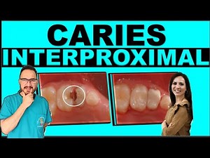 Interproximal Caries Index: Everything Every Parent Should Know!