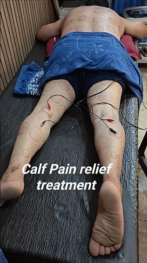 Calf Pain Relief Treatment | Dry Needling, Shockwave Therapy, Cupping & Stretching | Physiotherapy