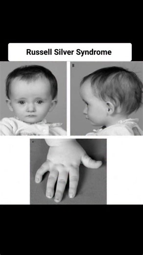 RK Medicos HUB on Instagram: "Russell-Silver syndrome (RSS), also known as Silver-Russell syndrome (SRS), is a rare genetic growth disorder present from birth. It is primarily characterized by slow growth before and after birth, leading to short stature. The condition affects roughly 1 in 15,000 to 100,000 people and occurs equally in males and females. Key Characteristics Children with RSS often have a distinct physical appearance, though symptoms vary: Growth: Low birth weight and height (smal