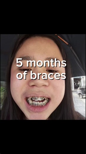 Braces Journey: 5 Months Transition and Self-Love