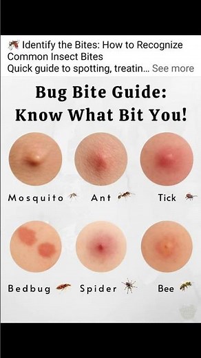 Bug Bite Guide: How to Identify What Bit You in Seconds!