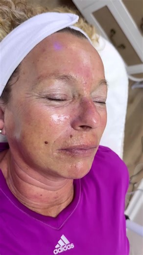 RF skin tightening   Hydrafacial