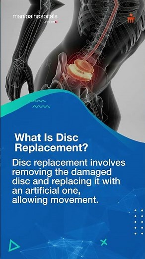 Disc Replacement Vs. Fusion | Dr. Ashish Dagar | Manipal Hospital Gurugram