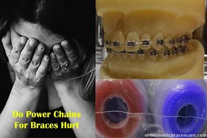 Do Power Chains For Braces Hurt [8 Tips for Pain Relief] - Orthodontic Braces Care