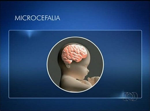 Saiba o que é microcefalia e quais as suas causas