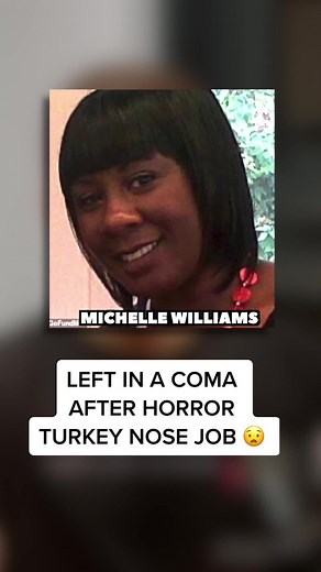The tragic horror story of Michelle Williams and her nightmare nose job in Turkey #nosejob #turkey #fredarthurpod #cosmeticsurgery #plasticsurgery