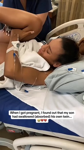 Surprising Fetus in Fetu Discovery During Pregnancy