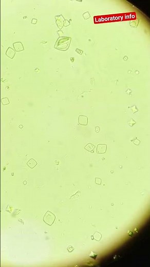 calcium oxalate and uric acid crystals in urine