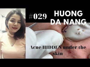 #029 |Acne HIDDEN under the skin | Acne treatment Hương Đà Nẵng Official