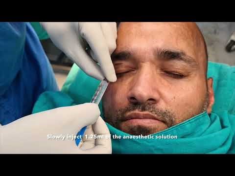 PERIBULBAR block or Frontal nerve block for forehead and scalp anesthesia.