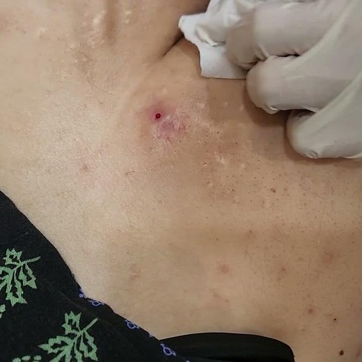 생기한의원 화농성한선염 치료