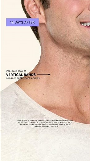 Before & After: Platysma Band Treatment in Men 🙌