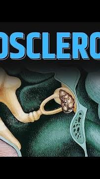 What happens in "Otosclerosis" ?