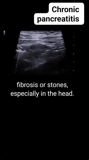 Chronic pancreatitis on ultrasound #fblifestyle #radiology #ultrasound #medical #radiologist | Radiology Interesting Cases