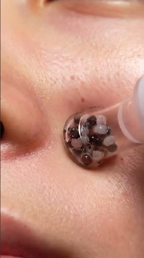 Deep Pore Blackhead Pop — Close Up