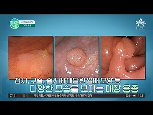 Polyps that can worsen into colorectal cancer! How to detect colorectal polyps #ColorectalCancer ...