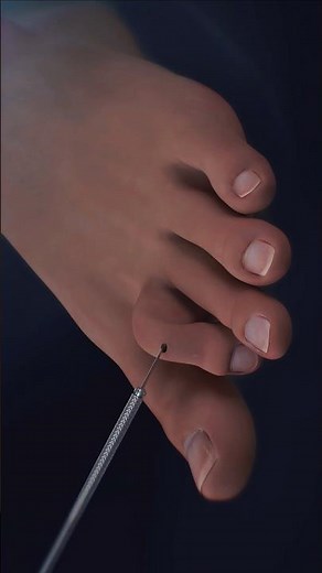 What is hammertoe Surgery? Surgical procedure to straighten toes #medical3danimation
