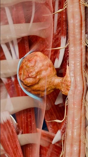 What is an intradural schwannoma and how does it affect the nervous system? A 3D exploration