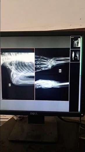 X-ray Image Setup in Fujifilm CR System #xray #radiographerusn