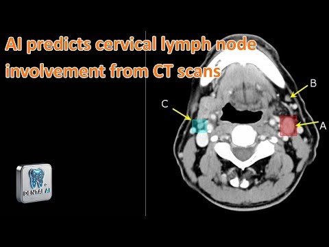 AI predicts cervical lymph node involvement from CT scans