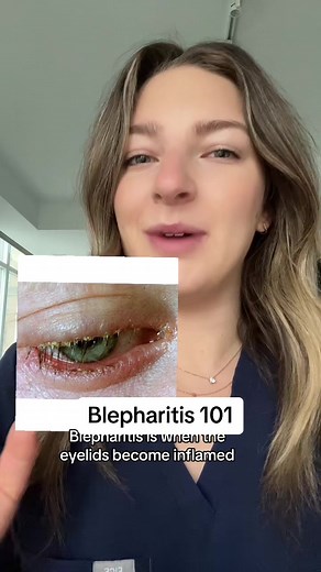 How to prevent blepharitis! #blepharitis #dryeye #styes #optometrist