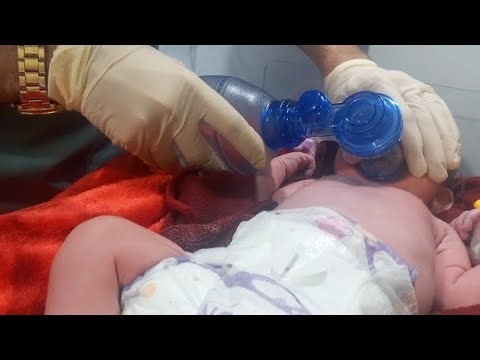 When a Newborn Has No Respiration 😢 | Life-Saving NICU Resuscitation