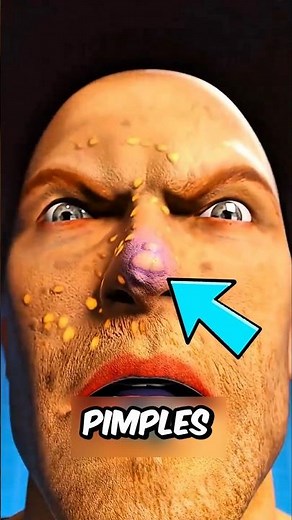 Popping Pimples? You’re Making It WAY Worse
