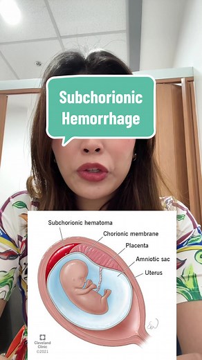 Understanding Subchorionic Hemorrhage: Symptoms and Treatment Options