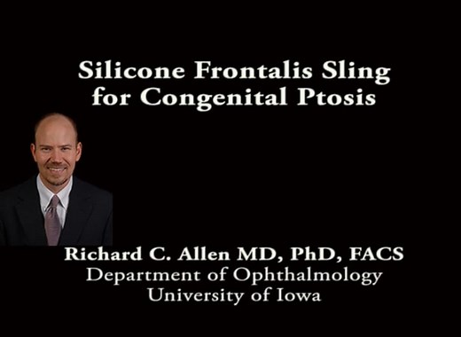Silicone frontalis sling for congenital ptosis