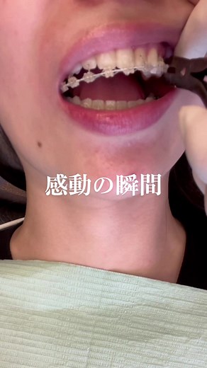 矯正しているみんなが待ち望んでいる瞬間 🥺 #ワイヤー矯正#ヒカキンボイス