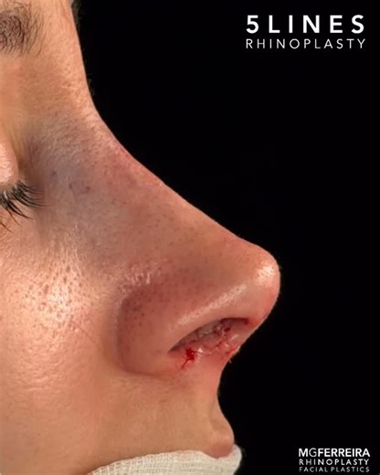 Prof Dr Miguel Ferreira | Rinoplastia on Instagram: "Make rhinoplasty simple 5 lines The way we shape the nasal tip has evolved significantly over recent years. The three-dimensional architecture of the final tip has progressively changed as a result of innovative solutions introduced by colleagues worldwide. The strategy we currently perform and propose is the outcome of multiple refinements—some established, some newly introduced—that together lead to a stable and long-lasting tip result. Want