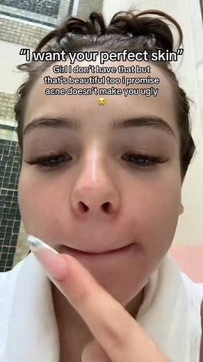 I love you and your gooey bumps #acne | Talissa Smalley