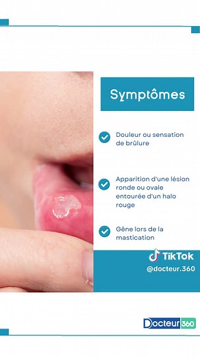 Comprendre les aphtes : causes et traitements